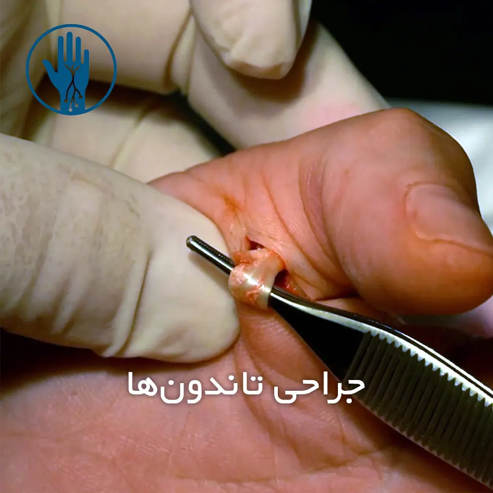 جراحی تاندون‌ها​
