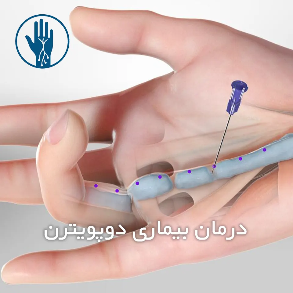 درمان بیماری دوپویترن​