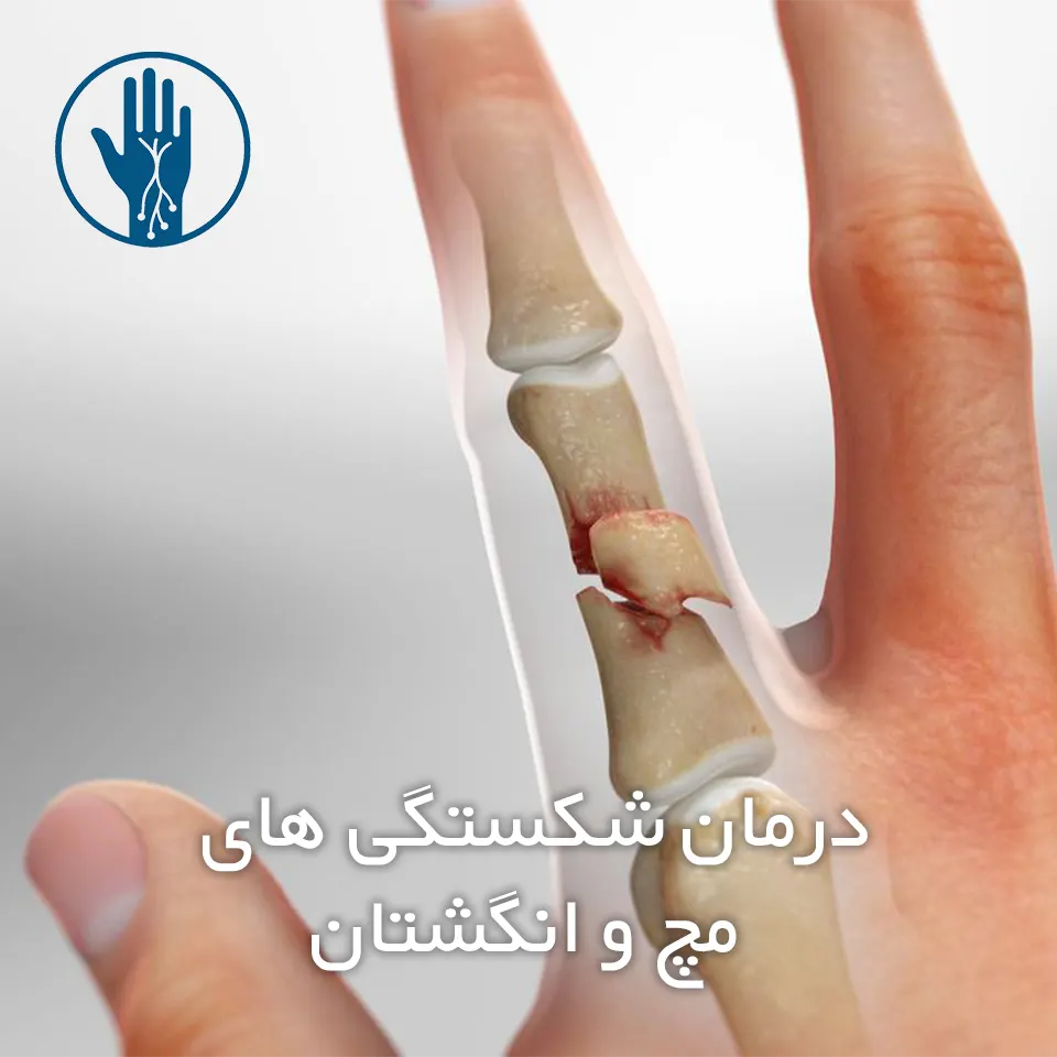 درمان شکستگی های مچ و انگشتان