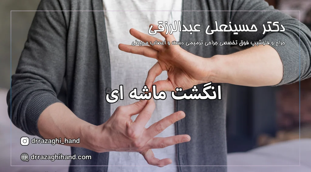 انگشت ماشه ای